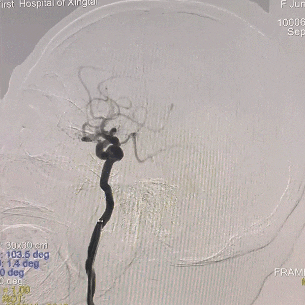 动脉长鞘怎么置入一技之“长”丨经桡及经股困难入路应用赛诺神畅APEX TRA GC™导引导管建立通路病例合集_https://www.jmylbn.com_新闻资讯_第17张