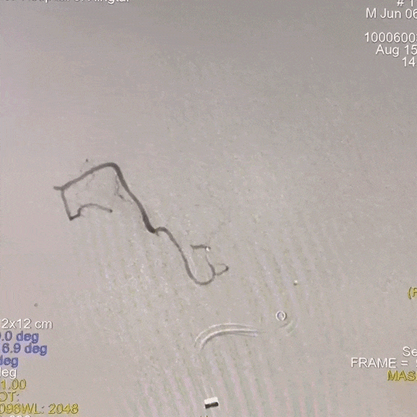 动脉长鞘怎么置入一技之“长”丨经桡及经股困难入路应用赛诺神畅APEX TRA GC™导引导管建立通路病例合集_https://www.jmylbn.com_新闻资讯_第40张