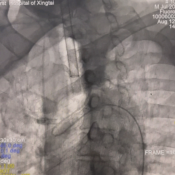动脉长鞘怎么置入一技之“长”丨经桡及经股困难入路应用赛诺神畅APEX TRA GC™导引导管建立通路病例合集_https://www.jmylbn.com_新闻资讯_第21张