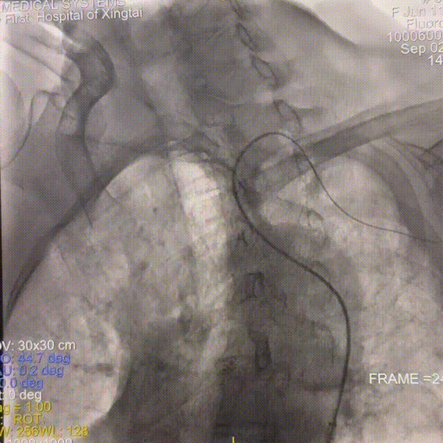 动脉长鞘怎么置入一技之“长”丨经桡及经股困难入路应用赛诺神畅APEX TRA GC™导引导管建立通路病例合集_https://www.jmylbn.com_新闻资讯_第8张