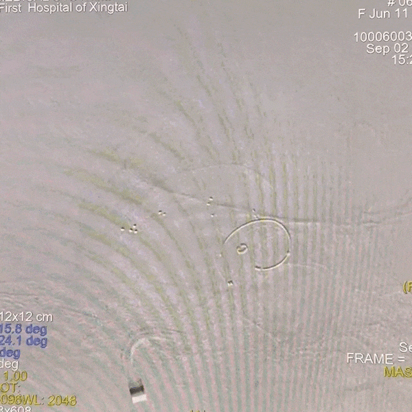 动脉长鞘怎么置入一技之“长”丨经桡及经股困难入路应用赛诺神畅APEX TRA GC™导引导管建立通路病例合集_https://www.jmylbn.com_新闻资讯_第12张