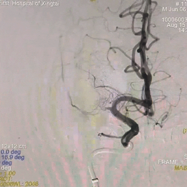 动脉长鞘怎么置入一技之“长”丨经桡及经股困难入路应用赛诺神畅APEX TRA GC™导引导管建立通路病例合集_https://www.jmylbn.com_新闻资讯_第38张