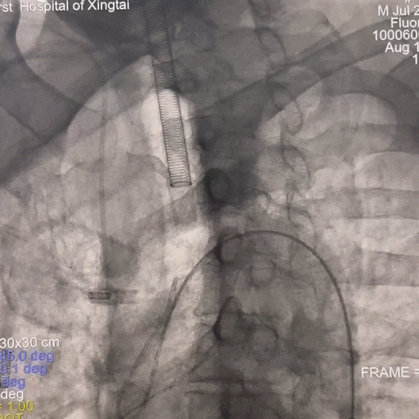 动脉长鞘怎么置入一技之“长”丨经桡及经股困难入路应用赛诺神畅APEX TRA GC™导引导管建立通路病例合集_https://www.jmylbn.com_新闻资讯_第22张