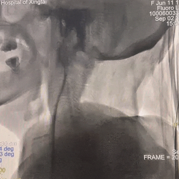 动脉长鞘怎么置入一技之“长”丨经桡及经股困难入路应用赛诺神畅APEX TRA GC™导引导管建立通路病例合集_https://www.jmylbn.com_新闻资讯_第11张