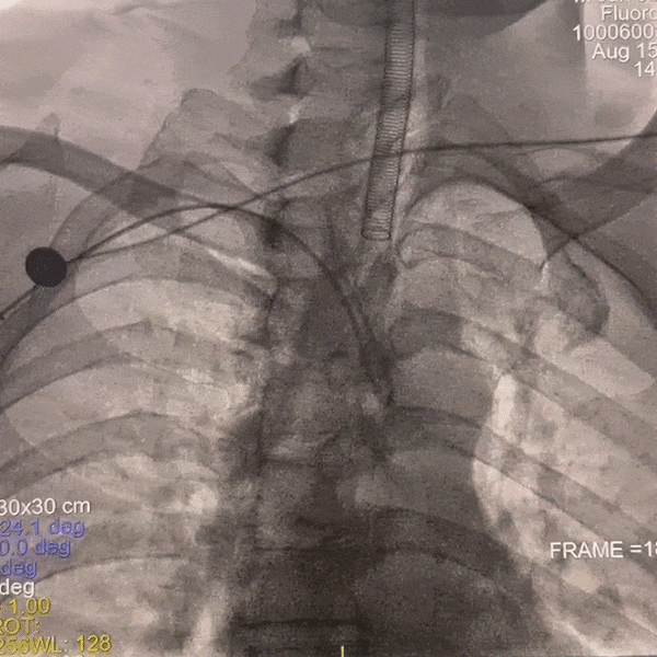 动脉长鞘怎么置入一技之“长”丨经桡及经股困难入路应用赛诺神畅APEX TRA GC™导引导管建立通路病例合集_https://www.jmylbn.com_新闻资讯_第34张
