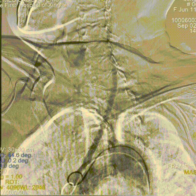 动脉长鞘怎么置入一技之“长”丨经桡及经股困难入路应用赛诺神畅APEX TRA GC™导引导管建立通路病例合集_https://www.jmylbn.com_新闻资讯_第7张