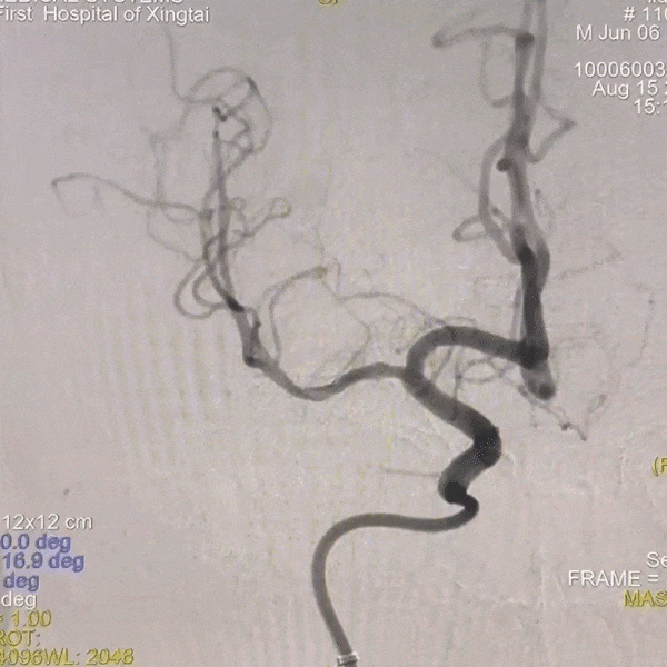 动脉长鞘怎么置入一技之“长”丨经桡及经股困难入路应用赛诺神畅APEX TRA GC™导引导管建立通路病例合集_https://www.jmylbn.com_新闻资讯_第45张