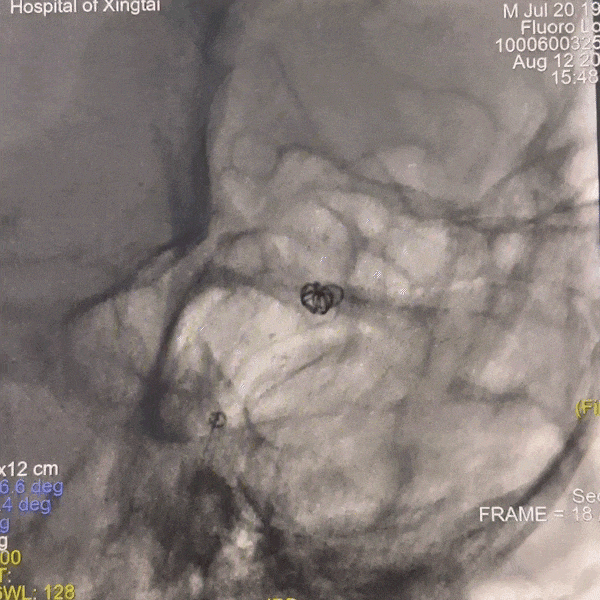 动脉长鞘怎么置入一技之“长”丨经桡及经股困难入路应用赛诺神畅APEX TRA GC™导引导管建立通路病例合集_https://www.jmylbn.com_新闻资讯_第24张