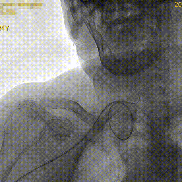 什么叫桡鞘【例久弥新】寻道于桡——瑞康通5.5F IntroSky X导管鞘经桡动脉行右侧大脑中动脉取栓一例_https://www.jmylbn.com_新闻资讯_第12张