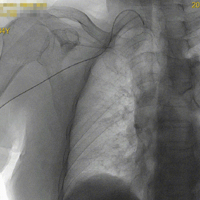 什么叫桡鞘【例久弥新】寻道于桡——瑞康通5.5F IntroSky X导管鞘经桡动脉行右侧大脑中动脉取栓一例_https://www.jmylbn.com_新闻资讯_第11张