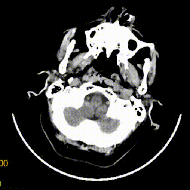 什么叫桡鞘【例久弥新】寻道于桡——瑞康通5.5F IntroSky X导管鞘经桡动脉行右侧大脑中动脉取栓一例_https://www.jmylbn.com_新闻资讯_第26张
