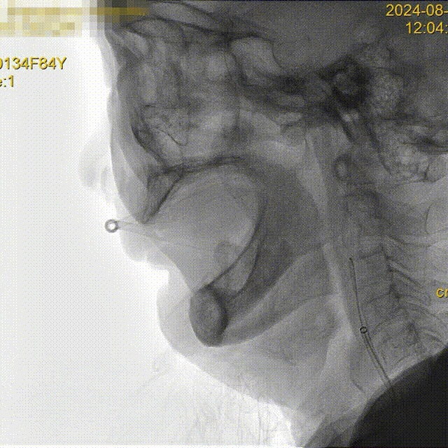 什么叫桡鞘【例久弥新】寻道于桡——瑞康通5.5F IntroSky X导管鞘经桡动脉行右侧大脑中动脉取栓一例_https://www.jmylbn.com_新闻资讯_第13张