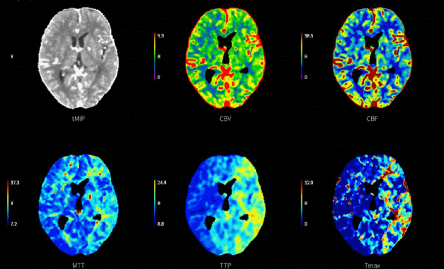 什么叫桡鞘【例久弥新】寻道于桡——瑞康通5.5F Introsky X导管鞘经桡取栓一例_https://www.jmylbn.com_新闻资讯_第6张