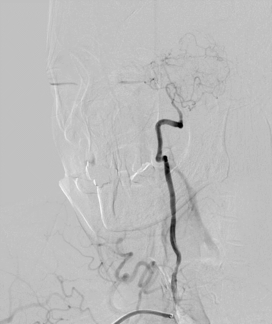 什么叫桡鞘【例久弥新】寻道于桡——瑞康通5.5F Introsky X导管鞘经桡取栓一例_https://www.jmylbn.com_新闻资讯_第10张