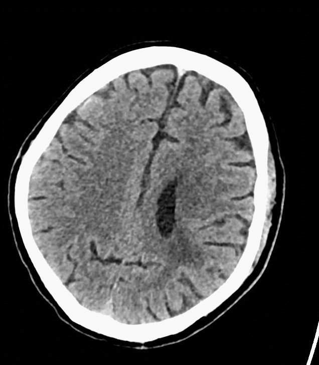 什么叫桡鞘【例久弥新】寻道于桡——瑞康通5.5F Introsky X导管鞘经桡取栓一例_https://www.jmylbn.com_新闻资讯_第4张