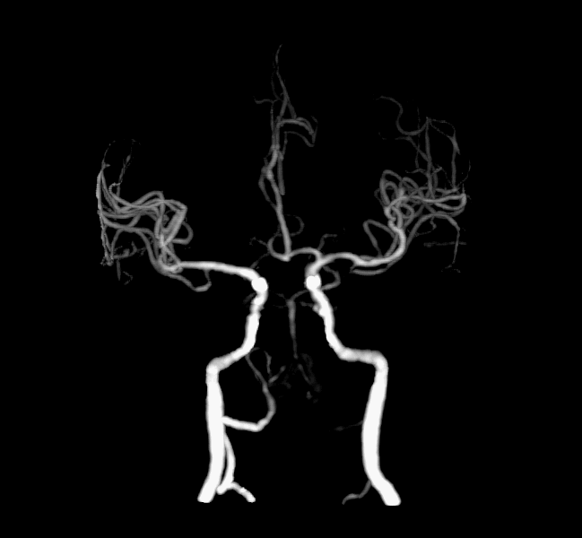 什么叫桡鞘【例久弥新】寻道于桡——瑞康通5.5F Introsky X导管鞘经桡取栓一例_https://www.jmylbn.com_新闻资讯_第31张