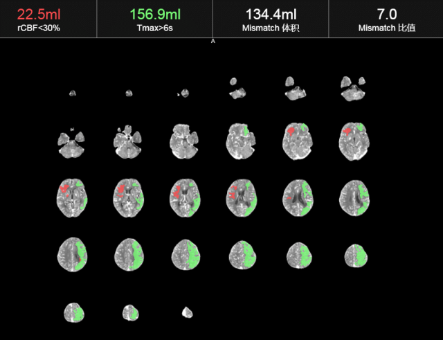 什么叫桡鞘【例久弥新】寻道于桡——瑞康通5.5F Introsky X导管鞘经桡取栓一例_https://www.jmylbn.com_新闻资讯_第7张