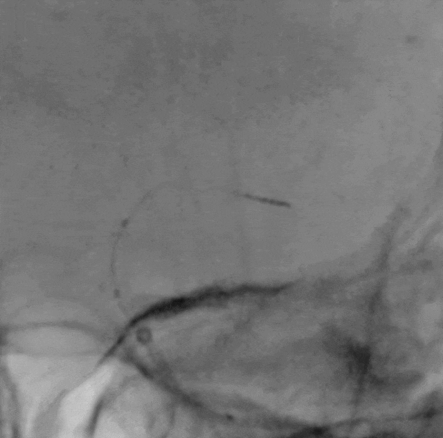 什么叫桡鞘【例久弥新】寻道于桡——瑞康通5.5F Introsky X导管鞘经桡取栓一例_https://www.jmylbn.com_新闻资讯_第24张
