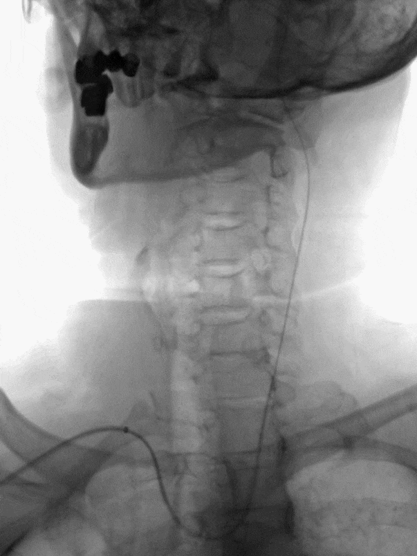 什么叫桡鞘【例久弥新】寻道于桡——瑞康通5.5F Introsky X导管鞘经桡取栓一例_https://www.jmylbn.com_新闻资讯_第14张