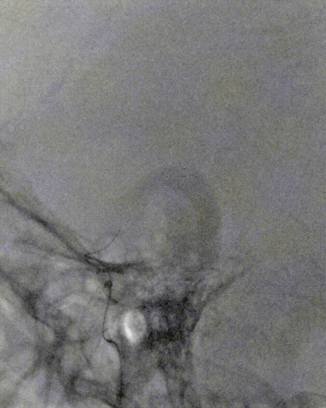 什么叫桡鞘【例久弥新】寻道于桡——瑞康通5.5F Introsky X导管鞘经桡取栓一例_https://www.jmylbn.com_新闻资讯_第18张