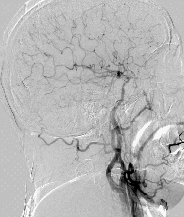 什么叫桡鞘【例久弥新】寻道于桡——瑞康通5.5F Introsky X导管鞘经桡取栓一例_https://www.jmylbn.com_新闻资讯_第9张