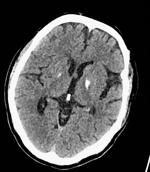什么叫桡鞘【例久弥新】寻道于桡——瑞康通5.5F Introsky X导管鞘经桡取栓一例_https://www.jmylbn.com_新闻资讯_第2张