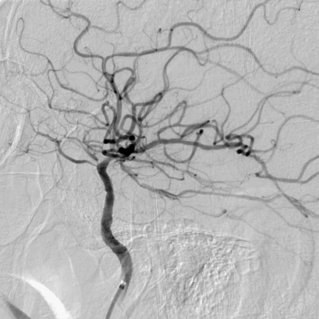 什么叫桡鞘【例久弥新】寻道于桡——瑞康通5.5F Introsky X导管鞘经桡取栓一例_https://www.jmylbn.com_新闻资讯_第26张