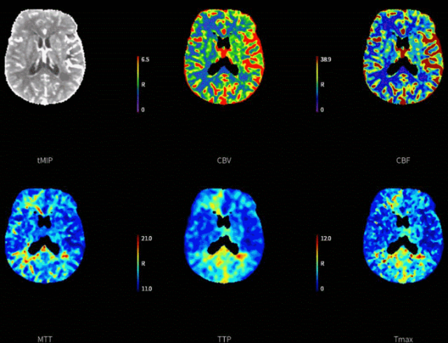 什么叫桡鞘【例久弥新】寻道于桡——瑞康通5.5F Introsky X导管鞘经桡取栓一例_https://www.jmylbn.com_新闻资讯_第32张