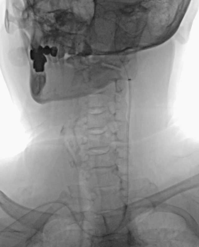什么叫桡鞘【例久弥新】寻道于桡——瑞康通5.5F Introsky X导管鞘经桡取栓一例_https://www.jmylbn.com_新闻资讯_第16张