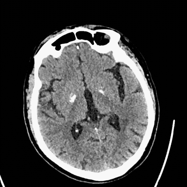 什么叫桡鞘【例久弥新】寻道于桡——瑞康通5.5F Introsky X导管鞘经桡取栓一例_https://www.jmylbn.com_新闻资讯_第28张