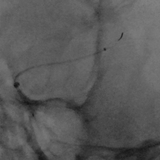 什么叫桡鞘【例久弥新】寻道于桡——瑞康通5.5F Introsky X导管鞘经桡取栓一例_https://www.jmylbn.com_新闻资讯_第20张