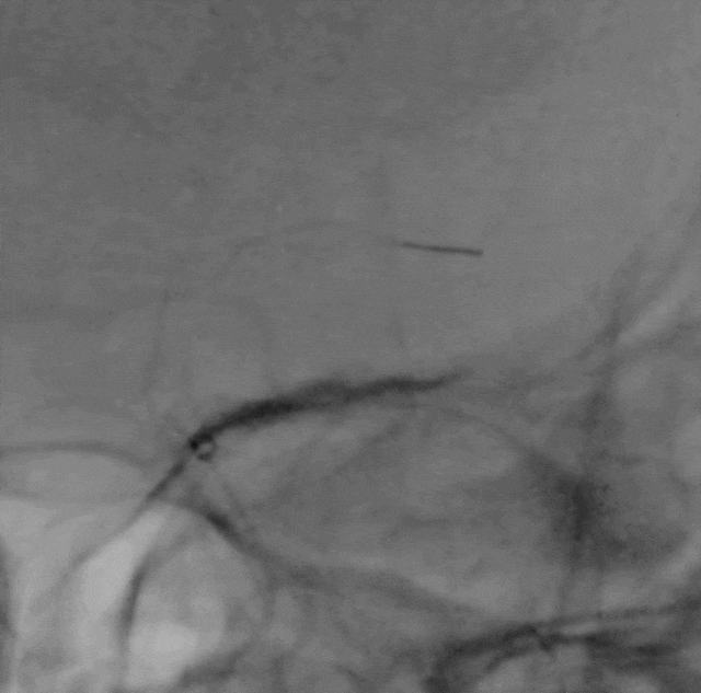 什么叫桡鞘【例久弥新】寻道于桡——瑞康通5.5F Introsky X导管鞘经桡取栓一例_https://www.jmylbn.com_新闻资讯_第23张