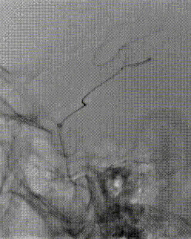 什么叫桡鞘【例久弥新】寻道于桡——瑞康通5.5F Introsky X导管鞘经桡取栓一例_https://www.jmylbn.com_新闻资讯_第19张