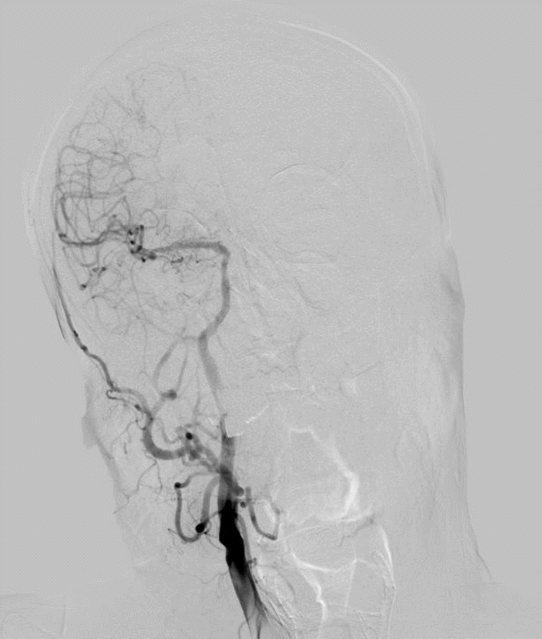 什么叫桡鞘【例久弥新】寻道于桡——瑞康通5.5F Introsky X导管鞘经桡取栓一例_https://www.jmylbn.com_新闻资讯_第8张