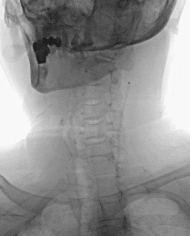 什么叫桡鞘【例久弥新】寻道于桡——瑞康通5.5F Introsky X导管鞘经桡取栓一例_https://www.jmylbn.com_新闻资讯_第17张
