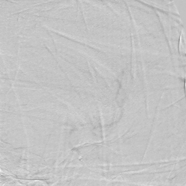 什么叫桡鞘【例久弥新】寻道于桡——瑞康通5.5F Introsky X导管鞘经桡取栓一例_https://www.jmylbn.com_新闻资讯_第22张