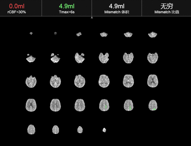 什么叫桡鞘【例久弥新】寻道于桡——瑞康通5.5F Introsky X导管鞘经桡取栓一例_https://www.jmylbn.com_新闻资讯_第33张