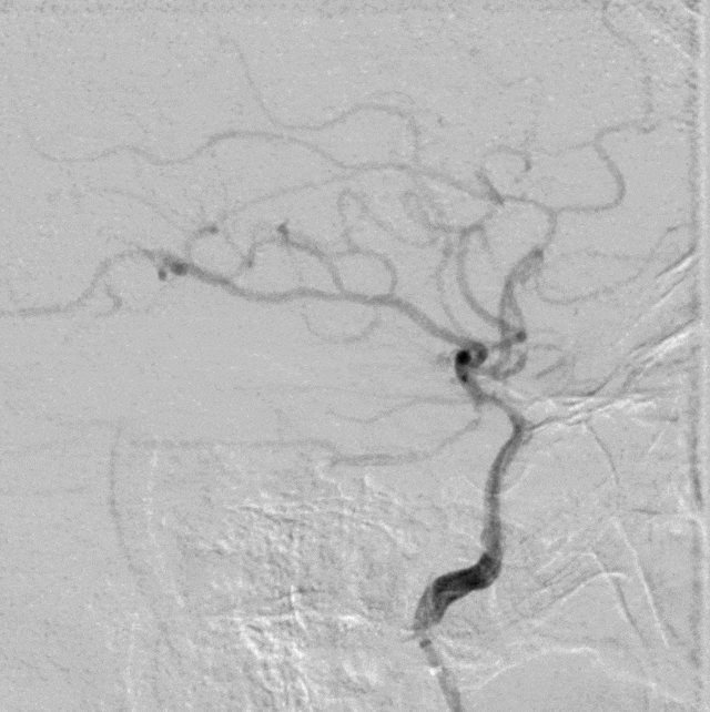 什么叫桡鞘【例久弥新】寻道于桡——瑞康通5.5F Introsky X导管鞘经桡取栓一例_https://www.jmylbn.com_新闻资讯_第27张