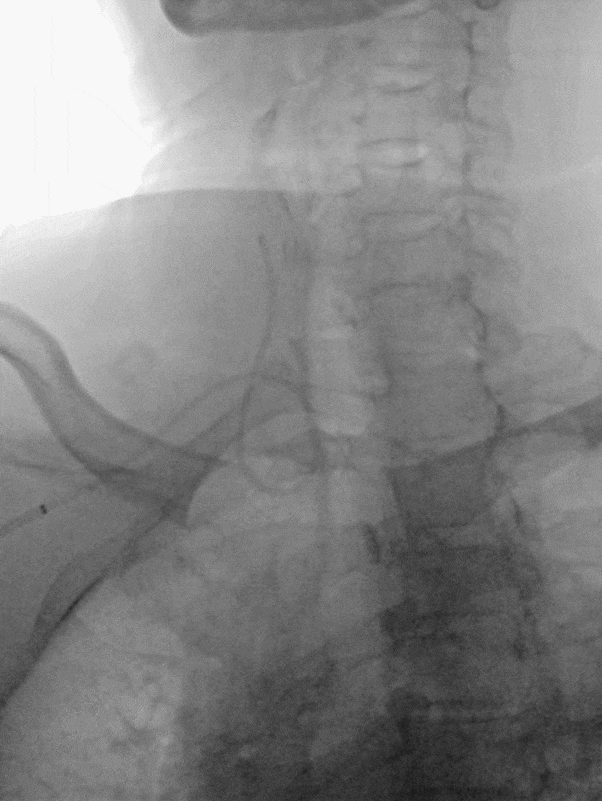 什么叫桡鞘【例久弥新】寻道于桡——瑞康通5.5F Introsky X导管鞘经桡取栓一例_https://www.jmylbn.com_新闻资讯_第13张