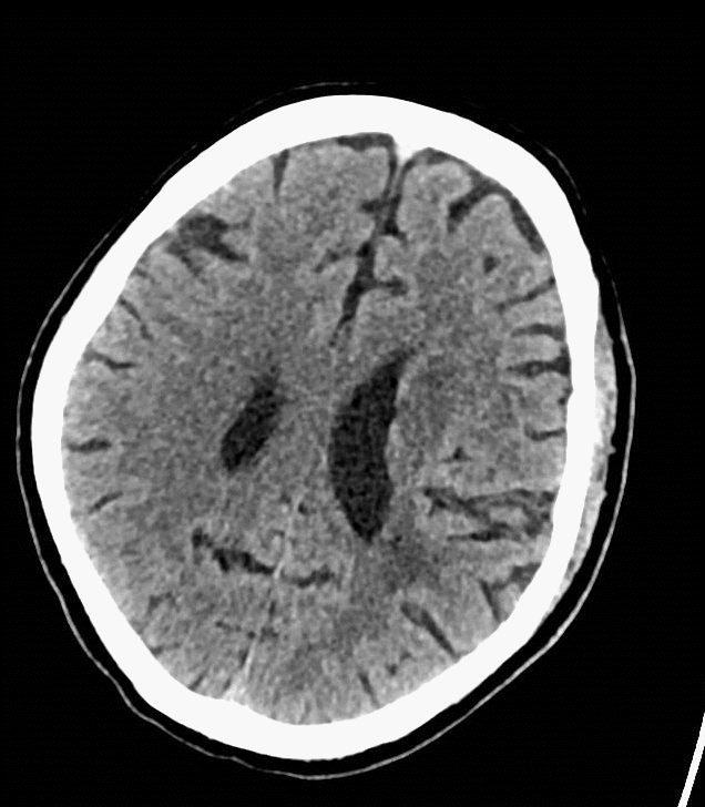 什么叫桡鞘【例久弥新】寻道于桡——瑞康通5.5F Introsky X导管鞘经桡取栓一例_https://www.jmylbn.com_新闻资讯_第3张