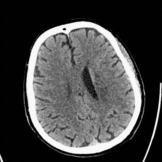 什么叫桡鞘【例久弥新】寻道于桡——瑞康通5.5F Introsky X导管鞘经桡取栓一例_https://www.jmylbn.com_新闻资讯_第29张