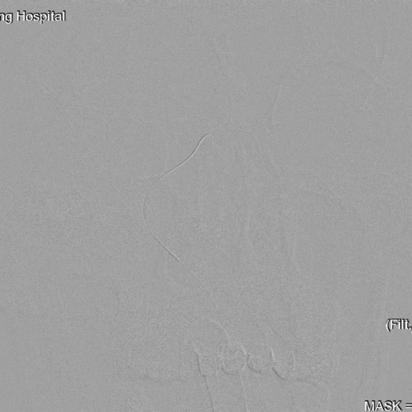 导丝怎么扩【载药时代 球扩天下】NOVA DES®颅内药物洗脱支架在症状性颅内动脉狭窄中的应用—烟台鲁东医院使用体会二例！_https://www.jmylbn.com_新闻资讯_第14张