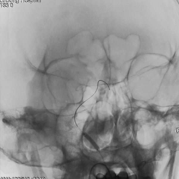 导丝怎么扩【载药时代 球扩天下】NOVA DES®颅内药物洗脱支架在症状性颅内动脉狭窄中的应用—烟台鲁东医院使用体会二例！_https://www.jmylbn.com_新闻资讯_第16张