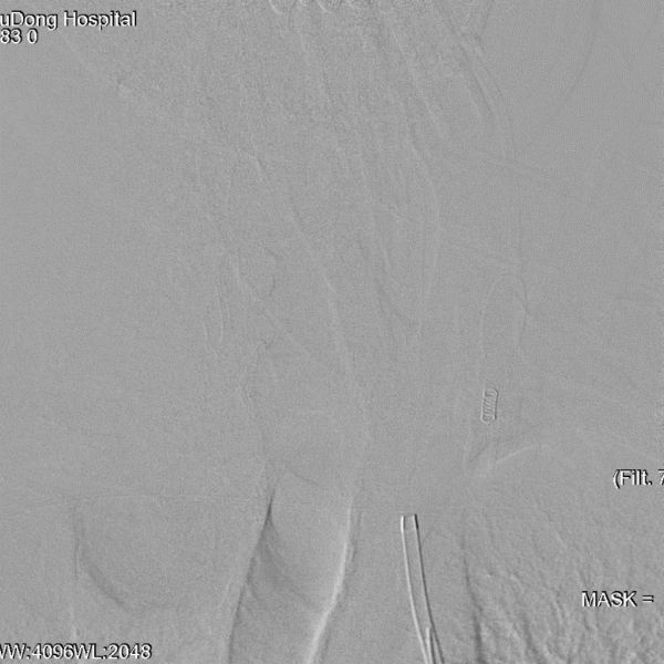 导丝怎么扩【载药时代 球扩天下】NOVA DES®颅内药物洗脱支架在症状性颅内动脉狭窄中的应用—烟台鲁东医院使用体会二例！_https://www.jmylbn.com_新闻资讯_第11张