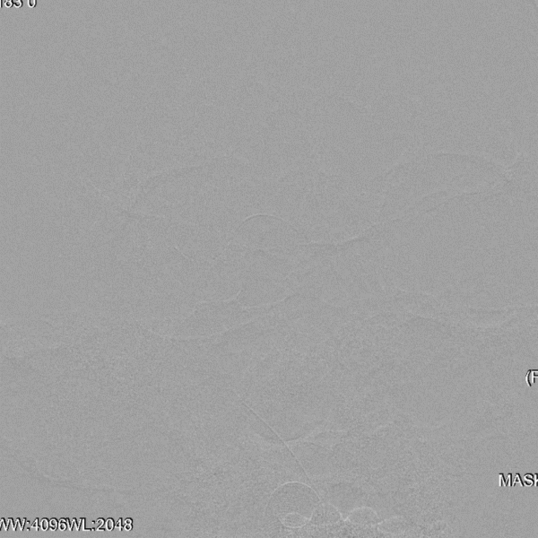 导丝怎么扩【载药时代 球扩天下】NOVA DES®颅内药物洗脱支架在症状性颅内动脉狭窄中的应用—烟台鲁东医院使用体会二例！_https://www.jmylbn.com_新闻资讯_第12张