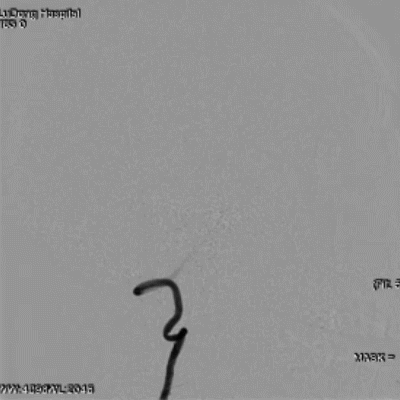 导丝怎么扩【载药时代 球扩天下】NOVA DES®颅内药物洗脱支架在症状性颅内动脉狭窄中的应用—烟台鲁东医院使用体会二例！_https://www.jmylbn.com_新闻资讯_第18张