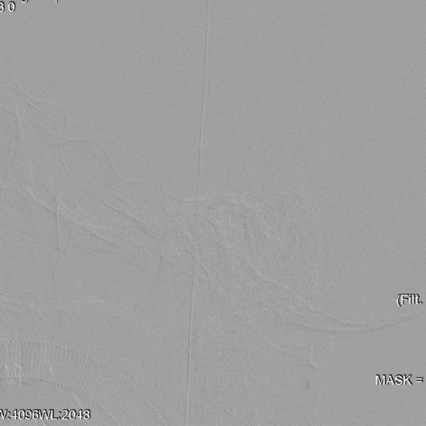 导丝怎么扩【载药时代 球扩天下】NOVA DES®颅内药物洗脱支架在症状性颅内动脉狭窄中的应用—烟台鲁东医院使用体会二例！_https://www.jmylbn.com_新闻资讯_第17张