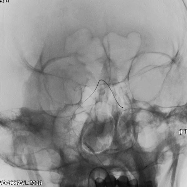 导丝怎么扩【载药时代 球扩天下】NOVA DES®颅内药物洗脱支架在症状性颅内动脉狭窄中的应用—烟台鲁东医院使用体会二例！_https://www.jmylbn.com_新闻资讯_第13张
