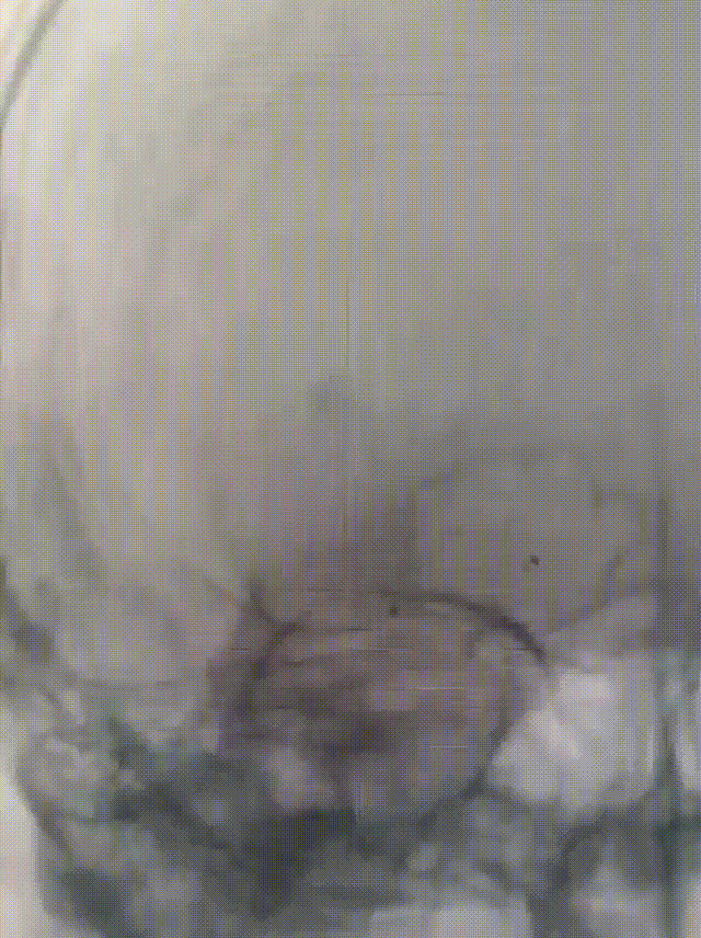 血管鞘组是什么【微妙通远】霍晓川、白晋、邴迎林：谱高PGGuider™导管鞘组联合SmartPioneer™在右侧大脑中动脉重度狭窄中应用一例_https://www.jmylbn.com_新闻资讯_第7张