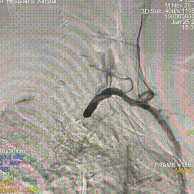 动脉长鞘怎么置入【有励可说】Locaste 088长鞘经左桡治疗左侧锁骨下动脉狭窄一例_https://www.jmylbn.com_新闻资讯_第6张